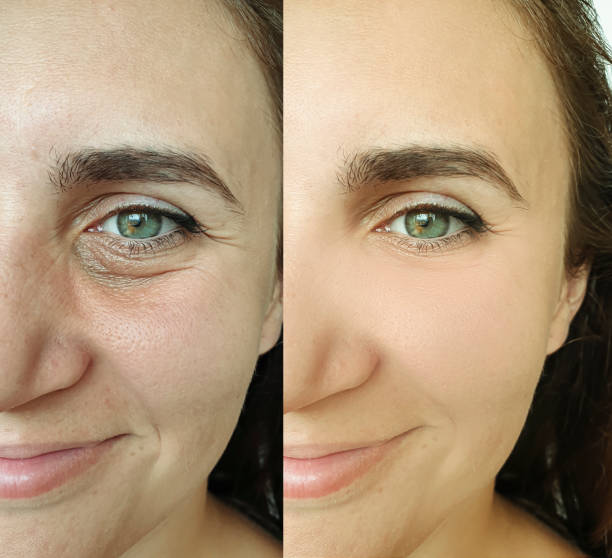 woman face wrinkles before and after treatment collage