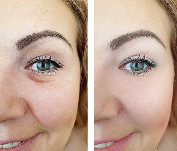 woman face eyes wrinkles before and after procedures