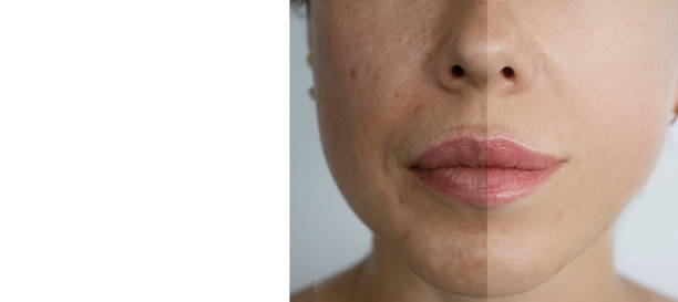 woman face wrinkles before and after treatment