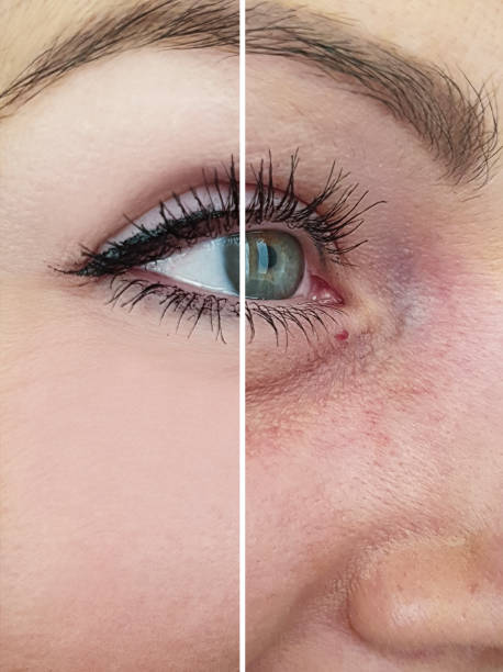 eyes of a woman wrinkles before and after procedures