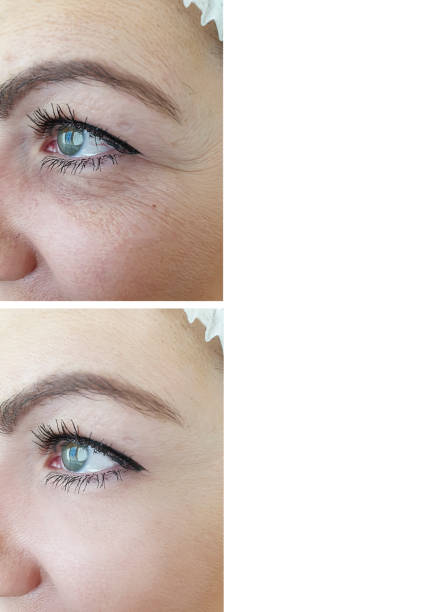 woman face wrinkles before and after correction