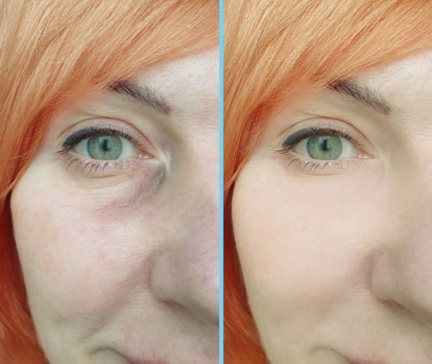 woman face wrinkles before and after treatment collage