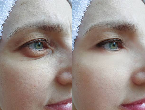 elderly woman face wrinkles before and after treatment