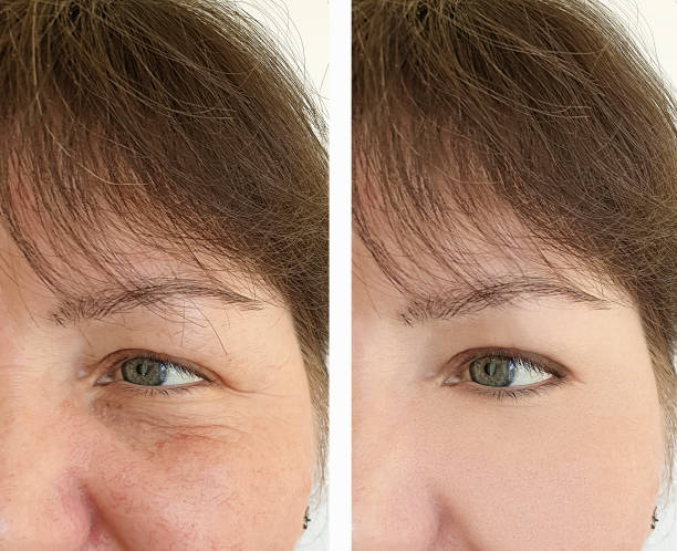 elderly woman face wrinkles before and after treatment