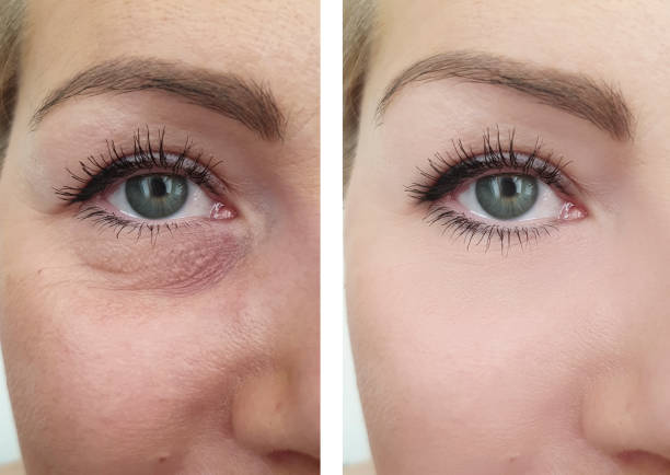 woman wrinkles before and after removal procedures