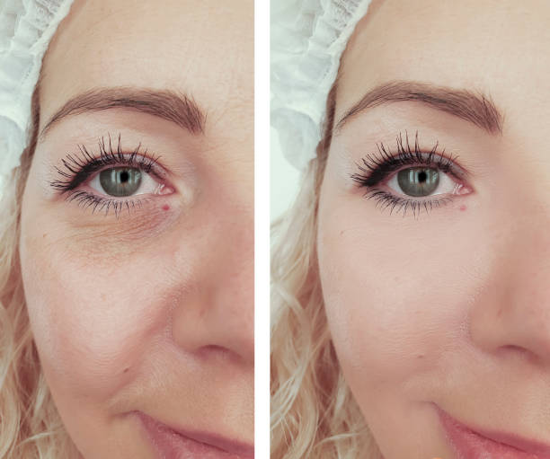 woman wrinkles face before and after correction procedures