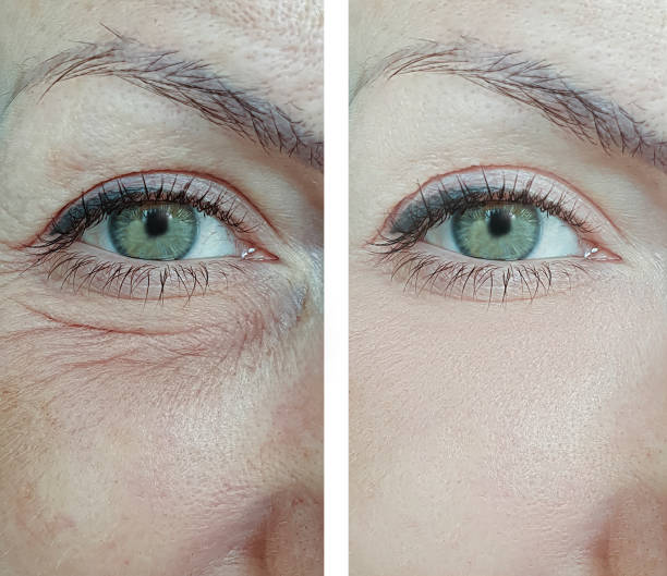 woman eyes wrinkles before and after treatment