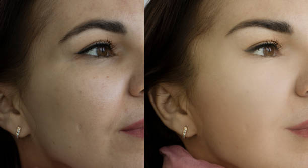 woman face wrinkles before and after treatment