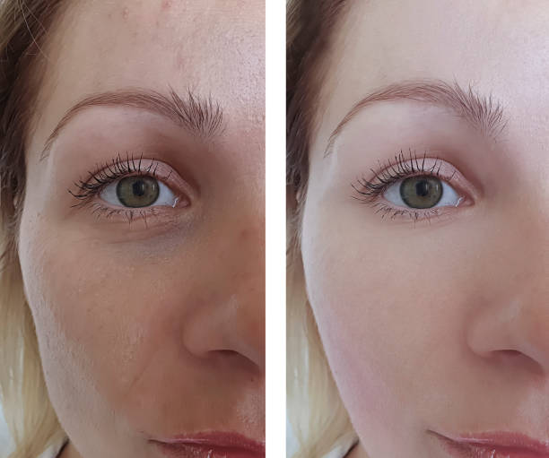woman wrinkles face before and after treatments