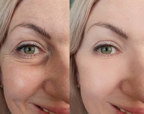 woman face wrinkles before and after treatment, collage