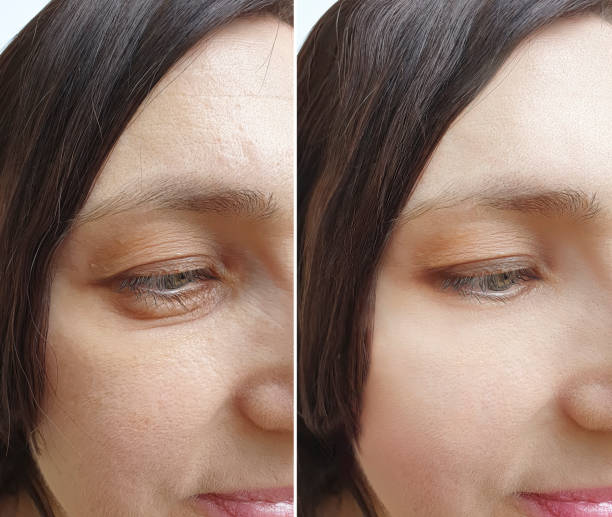 woman wrinkles face before and after treatment