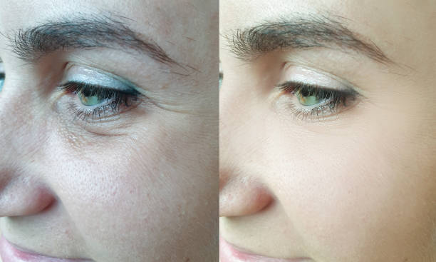 woman face wrinkles before and after treatment collage