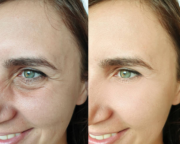 woman face wrinkles before and after treatment collage