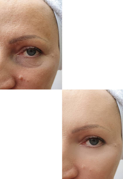 woman face wrinkles before and after correction