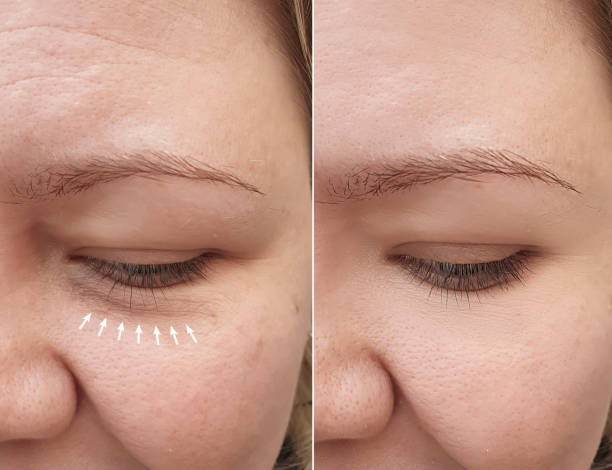 Caucasian girl face wrinkles after removal
