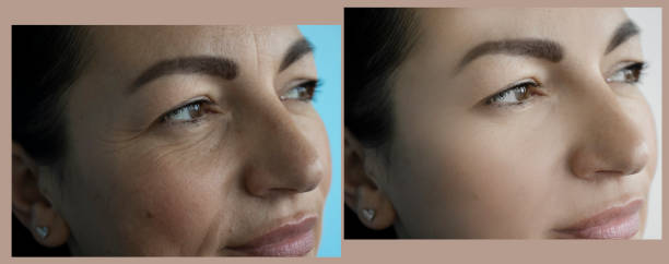 woman face wrinkles before and after treatment