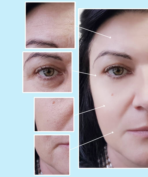 face woman wrinkles eyes before and after procedures, pigmentation
