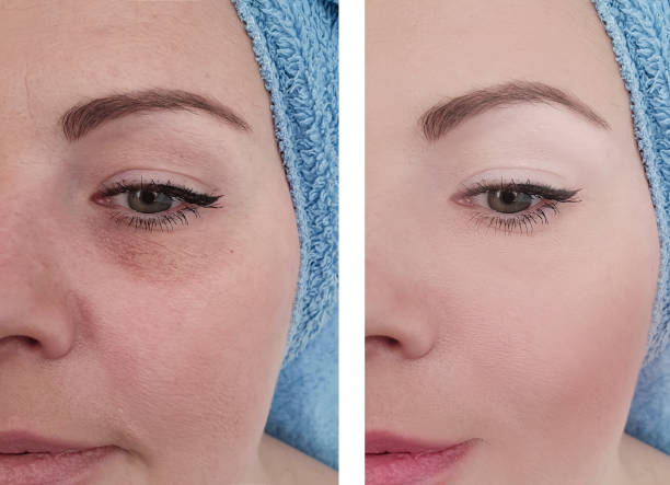woman face
wrinkles before and after treatments