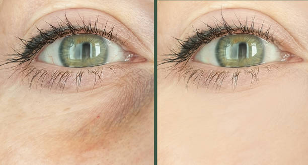 woman eyes wrinkles before and after treatment