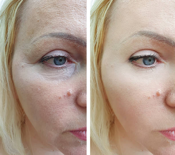 woman face wrinkles before and after treatment
