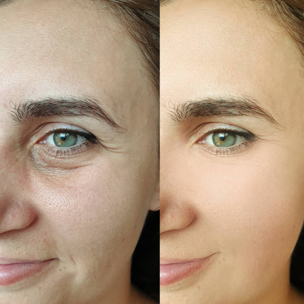 woman face wrinkles before and after treatment collage