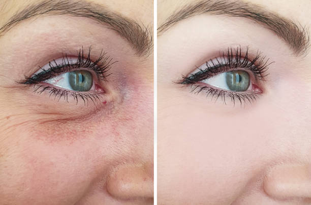 female eye wrinkles before and after correction procedures