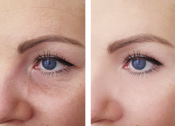 woman wrinkles face before and after correction procedures
