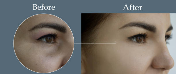 woman face wrinkles before and after treatment