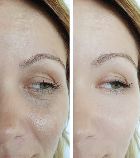 woman face wrinkles before and after treatment collage