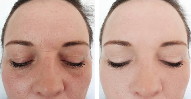 woman wrinkles face before and after procedures