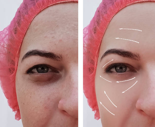 face beautiful girl face wrinkles before and after procedures, arrow