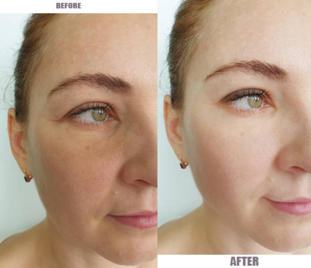 woman face wrinkles before and after treatment