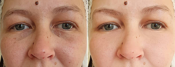 woman face wrinkles before and after treatment sagging