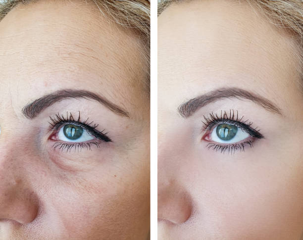 woman face wrinkles before and after procedures