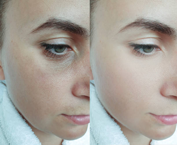 woman face wrinkles before and after treatment