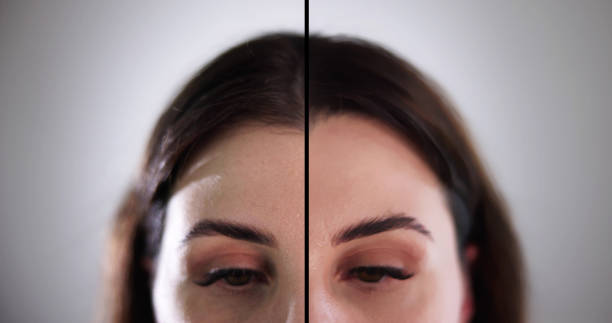 Anti Age Rejuvenation Forehead Lift Before And After