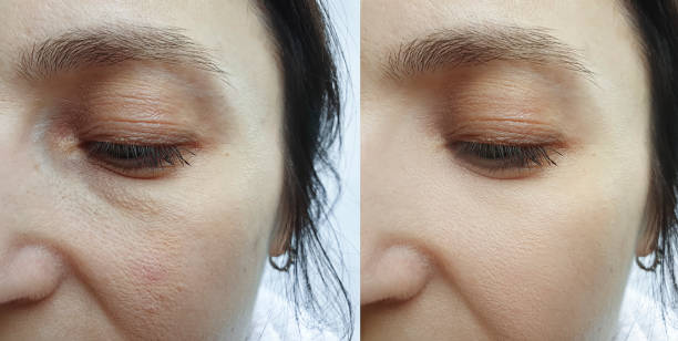 woman face wrinkles forehead before and after treatment