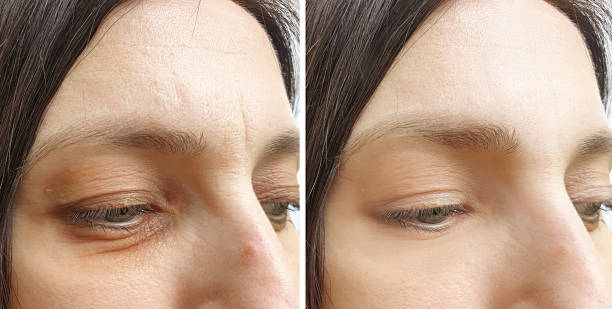 woman wrinkles face before and after procedures