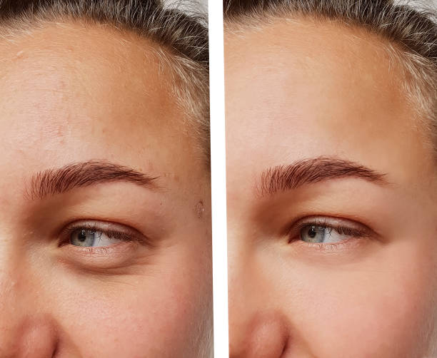 eye wrinkles young woman before and after cosmetic procedures