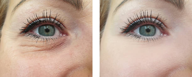 eyes of a woman wrinkles before and after procedures