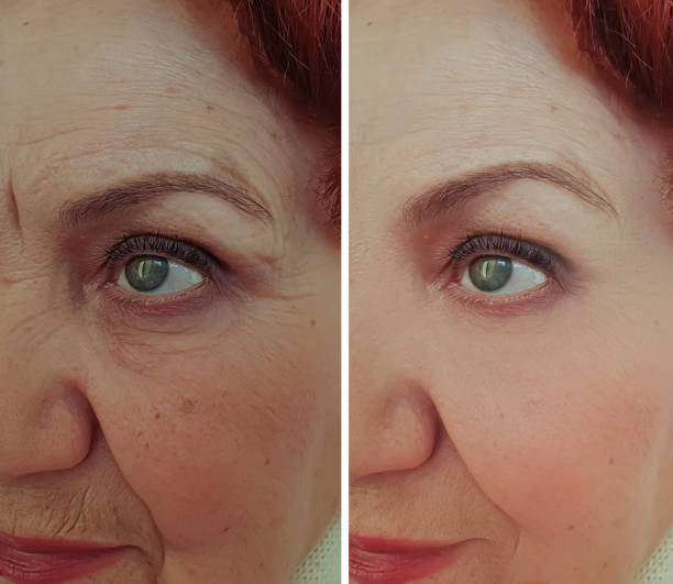 face old woman wrinkles before and after treatment