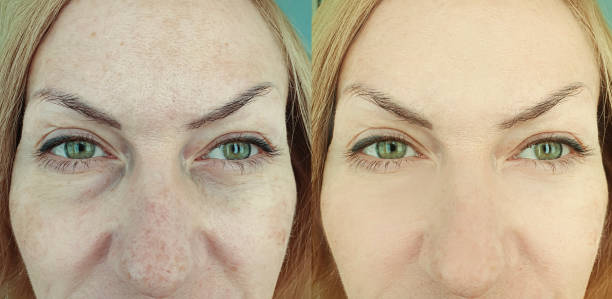 woman face wrinkles before and after treatment