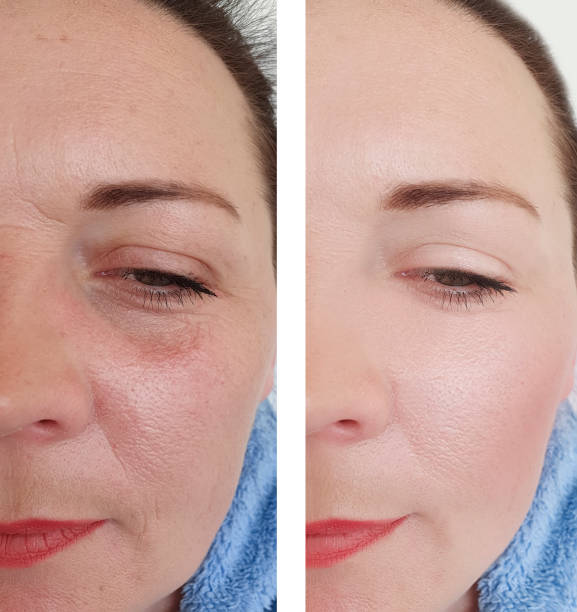 woman wrinkles before and after procedures