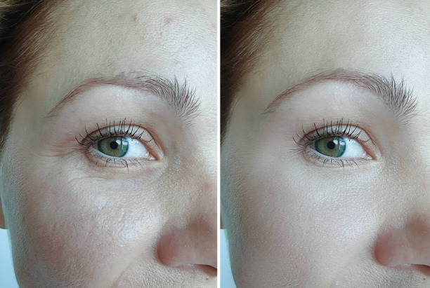 woman face wrinkles before and after treatment
