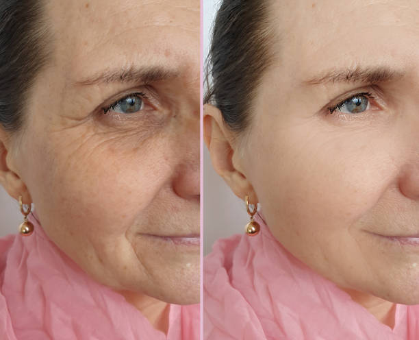 woman face wrinkles before and after treatment