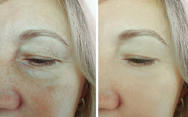 woman face wrinkles before and after treatment collage
