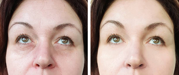 woman face wrinkle eyes before and after treatment