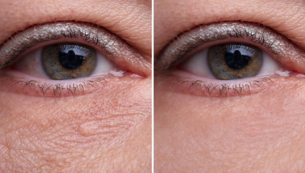 Close-up Of Woman's Eye Bags Before And After The Cosmetic Treatment
