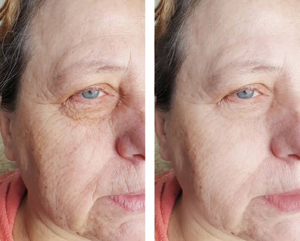 face of an elderly woman face wrinkles before and after procedures