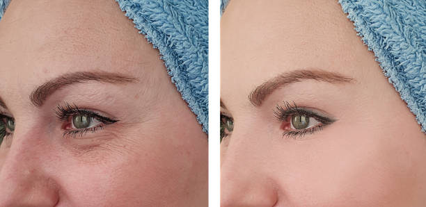 woman face
wrinkles before and after treatments